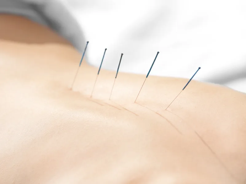 Acupuncture at Wellcare Chiropractic And Rehabilitation Clinic in houston