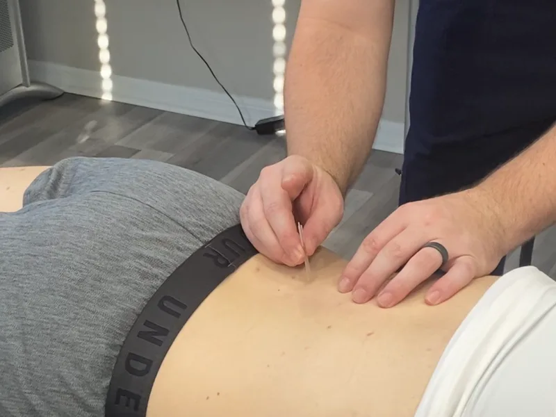 How Dry Needling works at Wellcare Chiropractic And Rehabilitation Clinic