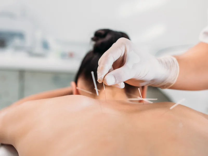 Dry Needling at Wellcare Chiropractic And Rehabilitation Clinic in houston